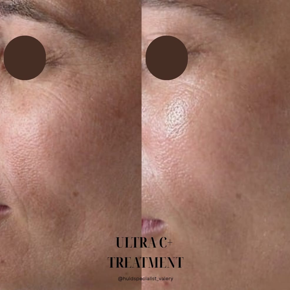 UltraC_peeling_pigmentbehandeling_chemischepeeling_delft_huidkliniek